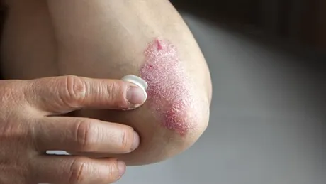 Tratamente naturale pentru psoriazis! Boala de piele poate fi tinuta sub control